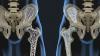 Pourquoi le calcium ne doit pas être prise pour l'ostéoporose? La vérité sur le calcium, et comment maintenir le tissu osseux en bonne forme