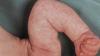 La peau « marbrée » du bébé: norme ou pathologie? Réponses du neurologue