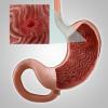 Gastrite, ou l'érosion de l'estomac: les principaux symptômes, le traitement, l'alimentation