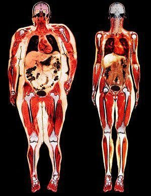 Gauche - juste l'obésité viscérale. Tous les organes étouffés avec de la graisse.