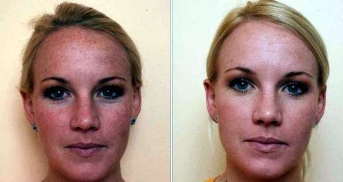 peler le carbone. Photos avant et après. Le patient a le type de peau grasse.