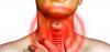 Tuberculose du larynx: les premiers signes de