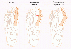 Comment enlever un os dans le pied