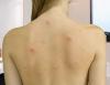 Comment se débarrasser de l'acné sur votre dos