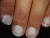 Pourquoi les ongles blanchissent