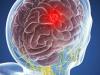 Tumeur du cerveau: 5 symptômes qui ne peut être ignoré