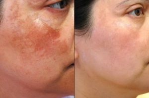 Le meilleur remède pour la pigmentation sur le visage, le cou et le décolleté. L'effet est immédiatement perceptible