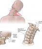 4 exercices de base pour la colonne cervicale aideront à oublier la douleur et osteochondrosis!