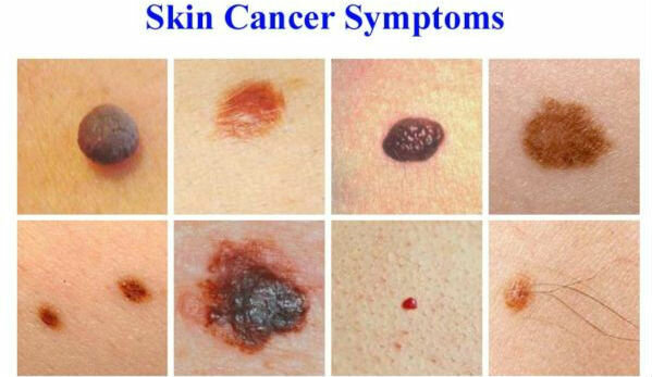 Les symptômes du cancer de la peau