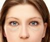 Comment se débarrasser de sans chirurgie, une hernie et les paupières inférieures poches sous les yeux